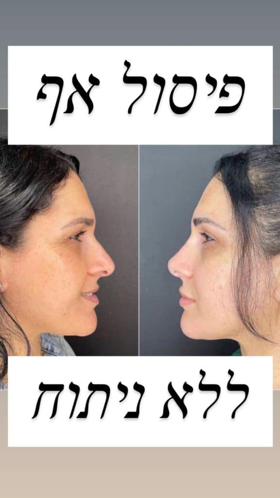 פיסול אף ללא ניתוח 